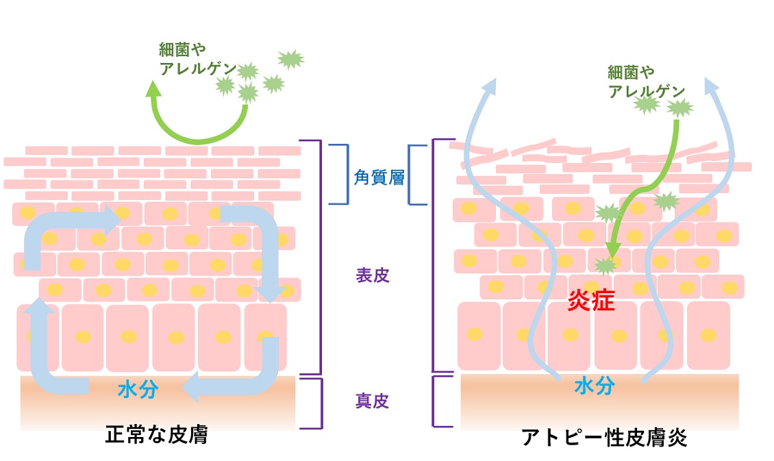 正常な皮膚とアトピー性皮膚炎